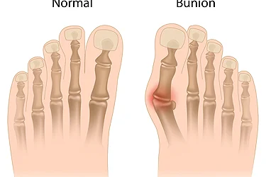 Overview of a Bunion