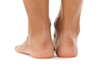 High Heels and Haglund’s Deformity: Why Shoe Choice Matters